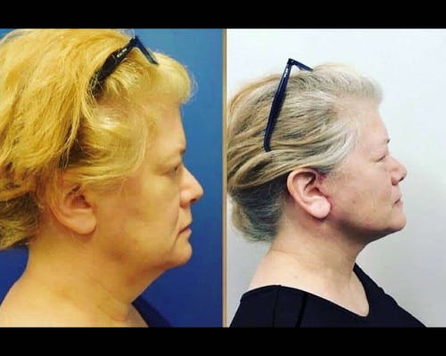 Deep Plane Facelift Before & After Gallery - Patient 323347 - Image 1