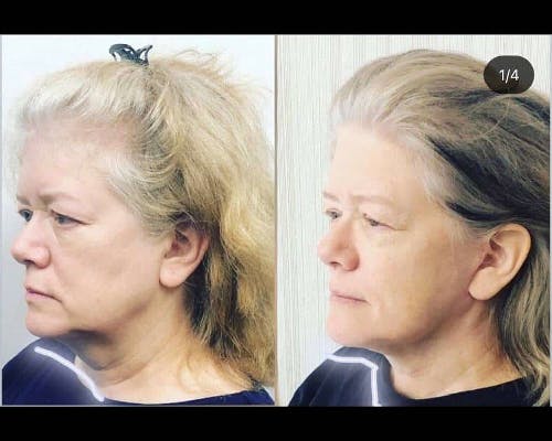 Deep Plane Facelift Before & After Gallery - Patient 323347 - Image 2