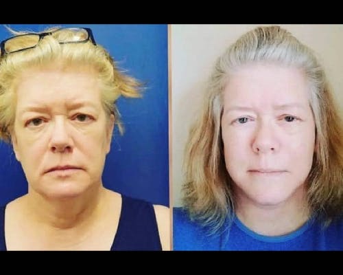 Deep Plane Facelift Before & After Gallery - Patient 323347 - Image 3