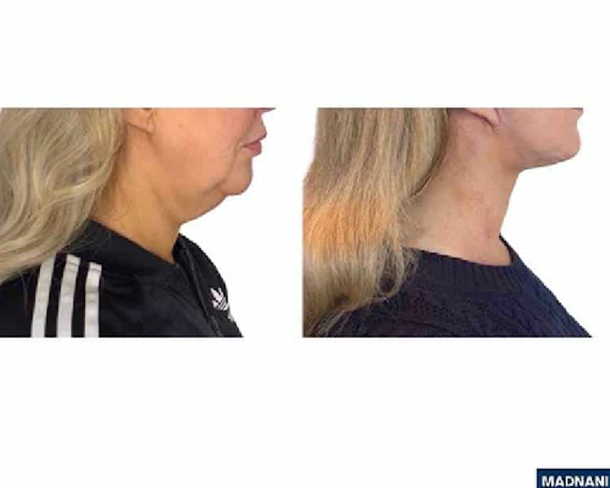 Deep Plane Facelift Before & After Gallery - Patient 360877 - Image 1
