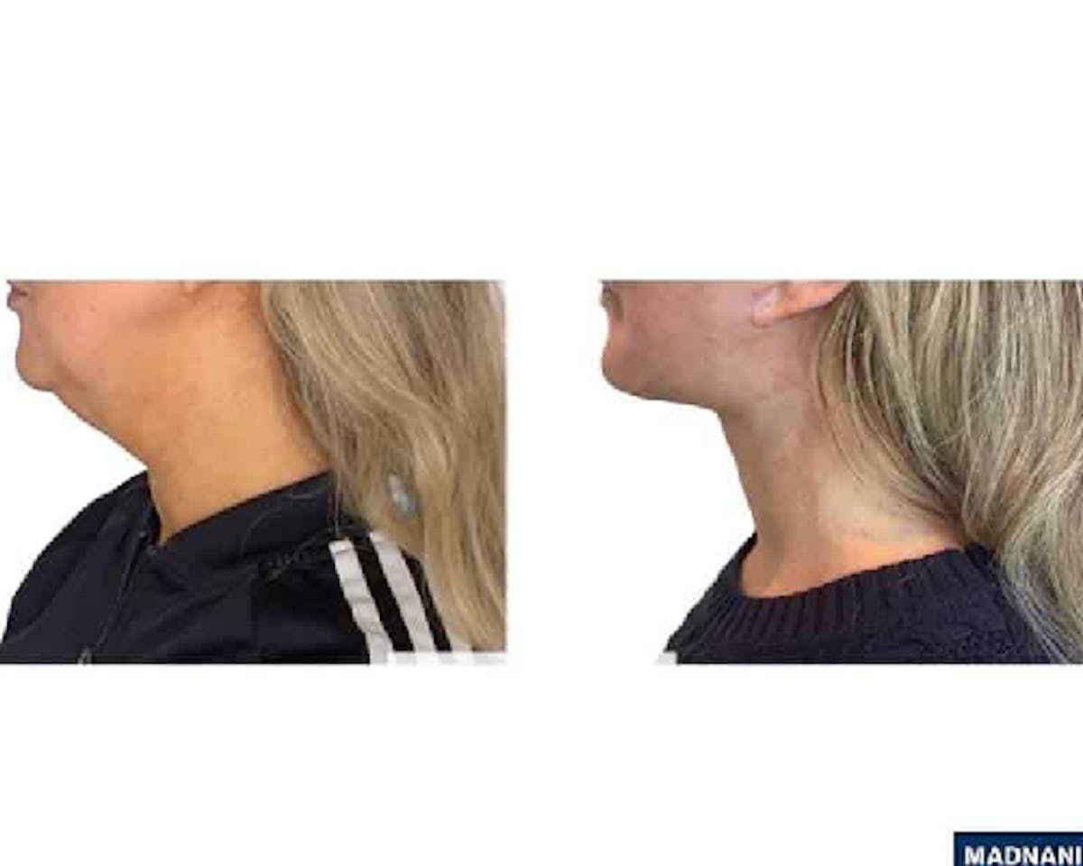 Deep Plane Facelift Before & After Gallery - Patient 360877 - Image 2