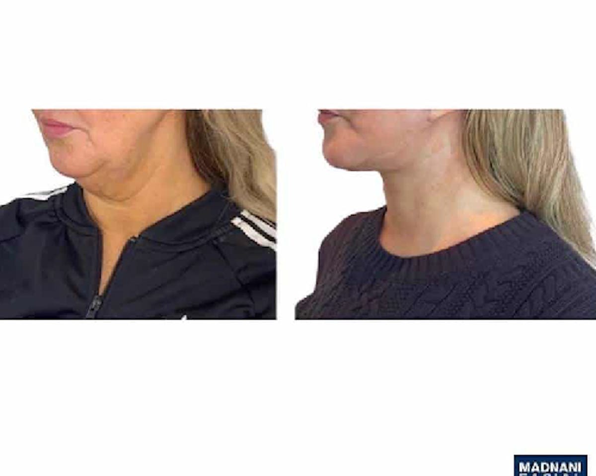 Deep Plane Facelift Before & After Gallery - Patient 360877 - Image 3