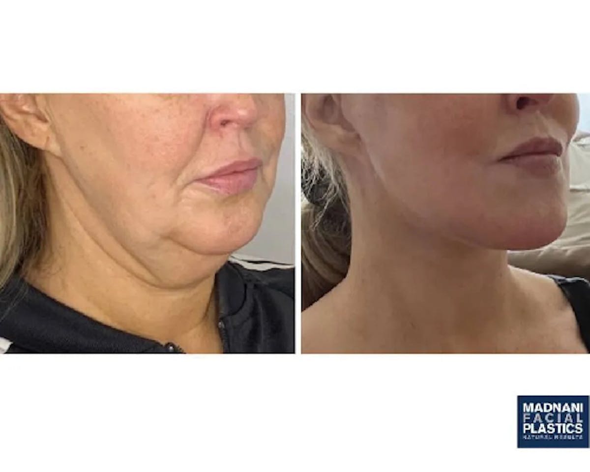 Deep Plane Facelift Before & After Gallery - Patient 360877 - Image 4