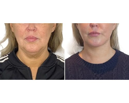 Deep Plane Facelift Before & After Gallery - Patient 360877 - Image 5