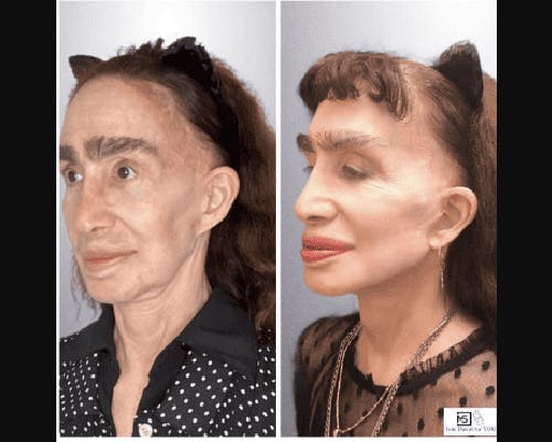 Deep Plane Facelift Before & After Gallery - Patient 272558 - Image 1