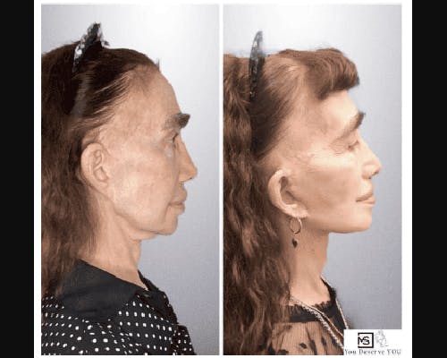 Deep Plane Facelift Before & After Gallery - Patient 272558 - Image 2