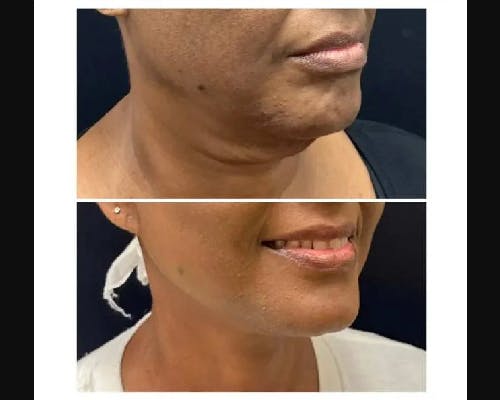 Ethnic Facelift Before & After Gallery - Patient 174370 - Image 1