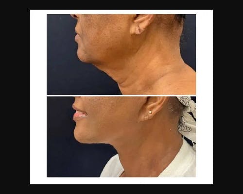 Ethnic Facelift Before & After Gallery - Patient 174370 - Image 2