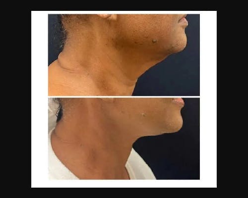 Ethnic Facelift Before & After Gallery - Patient 174370 - Image 3