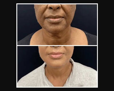 Deep Plane Facelift Before & After Gallery - Patient 242948 - Image 4