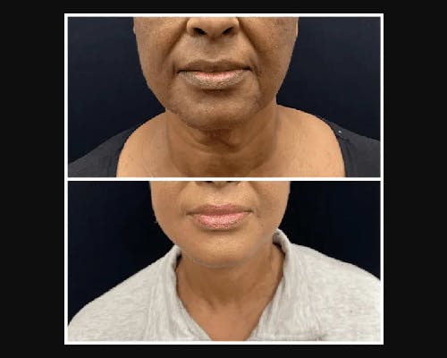 Ethnic Facelift Before & After Gallery - Patient 174370 - Image 4