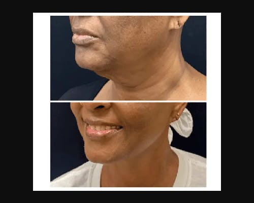 Ethnic Facelift Before & After Gallery - Patient 174370 - Image 5