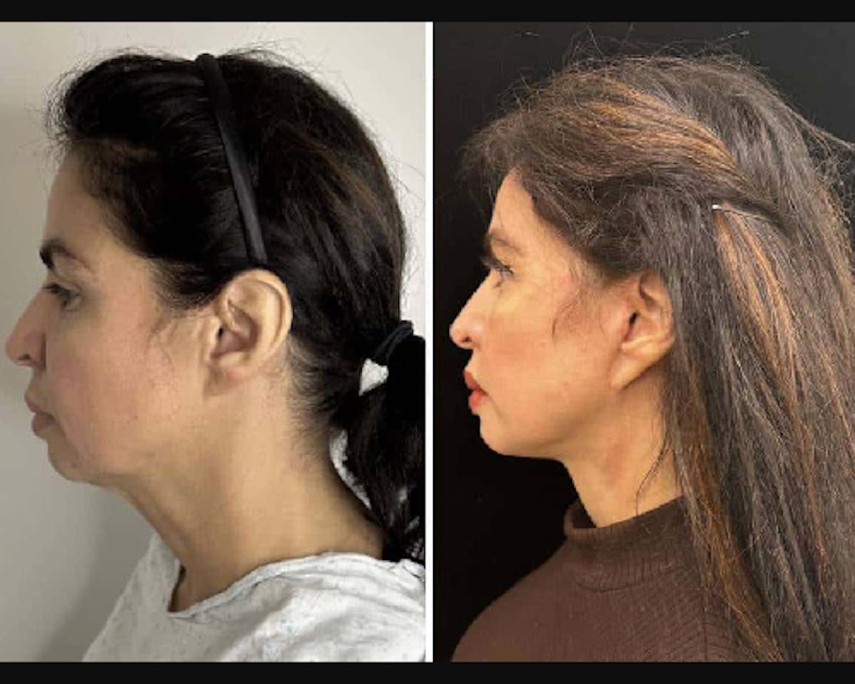 Ethnic Facelift Before & After Gallery - Patient 409989 - Image 1