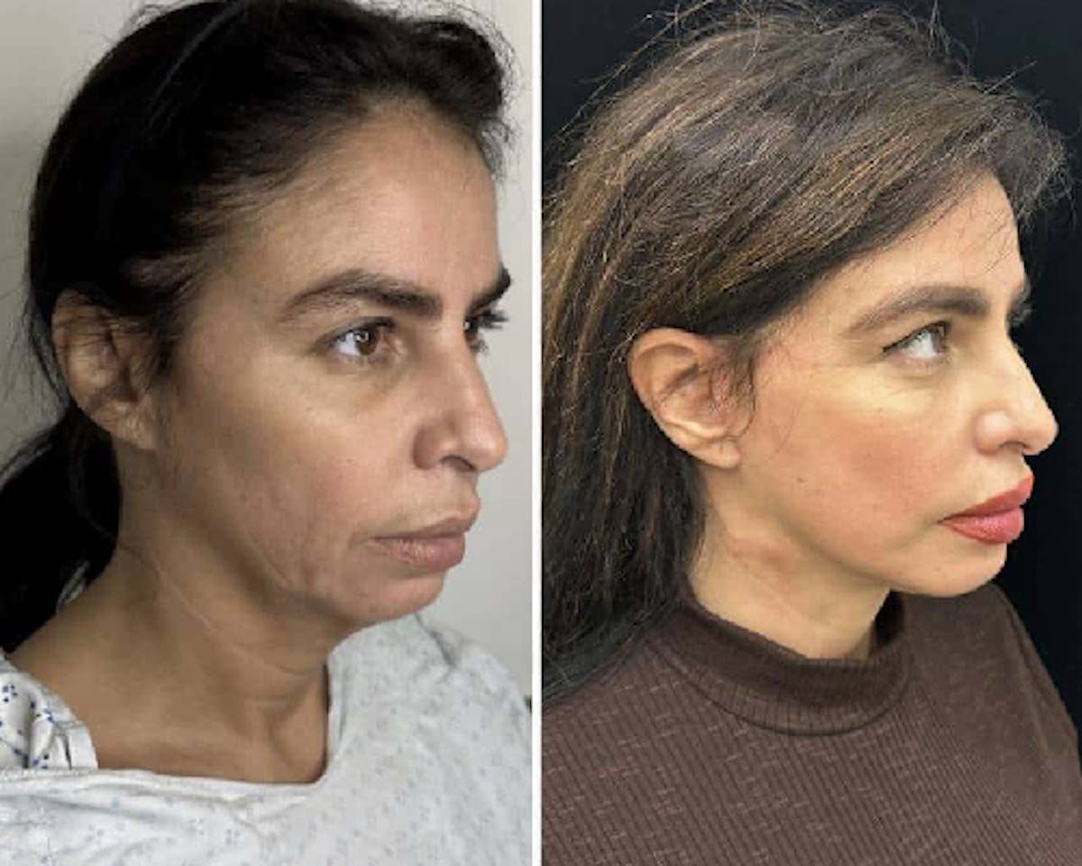 Ethnic Facelift Before & After Gallery - Patient 409989 - Image 2