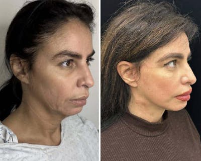 Deep Plane Facelift Before & After Gallery - Patient 117757 - Image 2