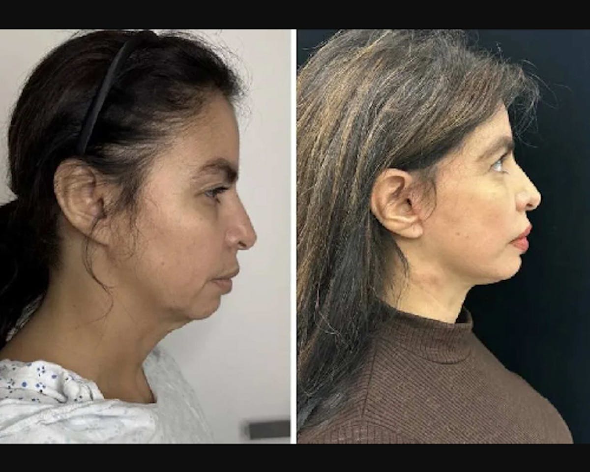 Ethnic Facelift Before & After Gallery - Patient 409989 - Image 3