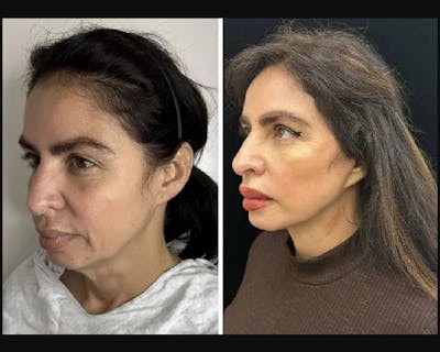 Deep Plane Facelift Before & After Gallery - Patient 117757 - Image 4