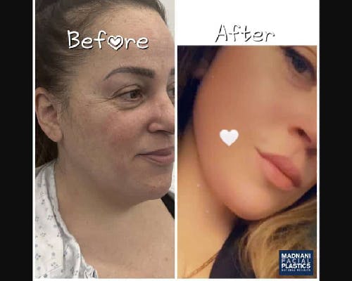 Deep Plane Facelift Before & After Gallery - Patient 229835 - Image 2