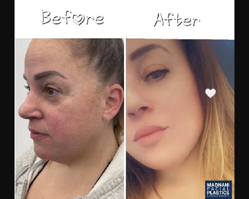 Deep Plane Facelift Before & After Gallery - Patient 229835 - Image 3