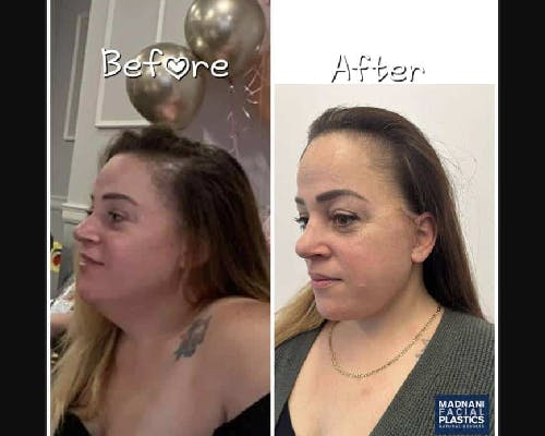 Deep Plane Facelift Before & After Gallery - Patient 229835 - Image 4