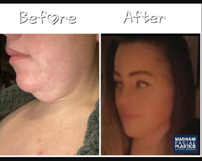 Deep Plane Facelift Before & After Gallery - Patient 229835 - Image 5