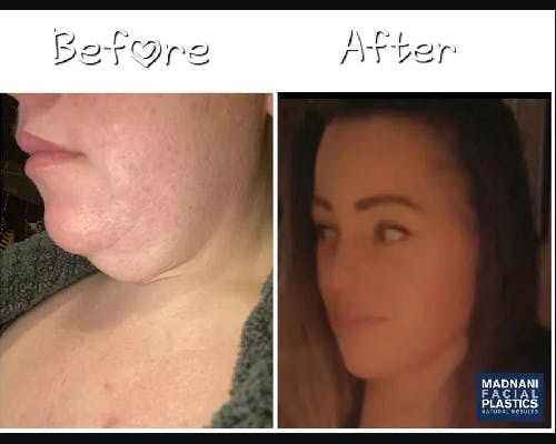 Deep Plane Facelift Before & After Gallery - Patient 229835 - Image 5