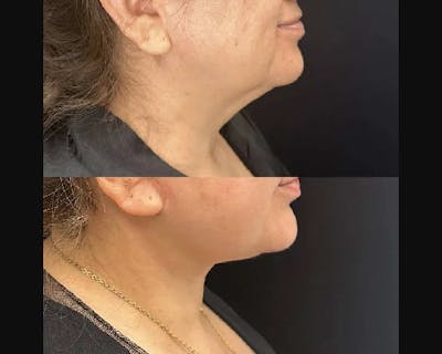 Deep Plane Facelift Before & After Gallery - Patient 260247 - Image 1