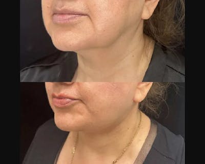 Deep Plane Facelift Before & After Gallery - Patient 260247 - Image 2