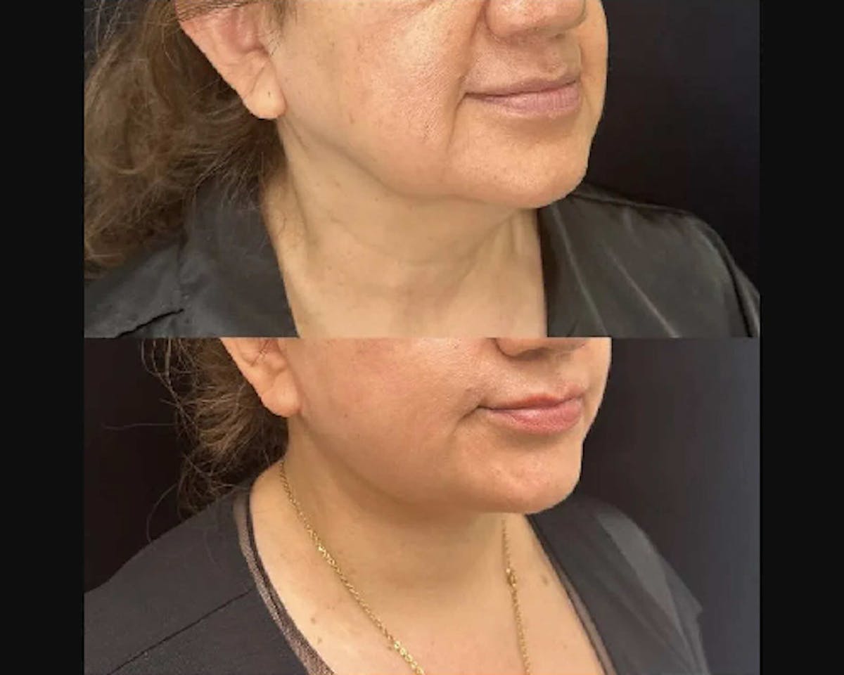 Deep Plane Facelift Before & After Gallery - Patient 260247 - Image 3