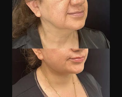 Deep Plane Facelift Before & After Gallery - Patient 260247 - Image 3