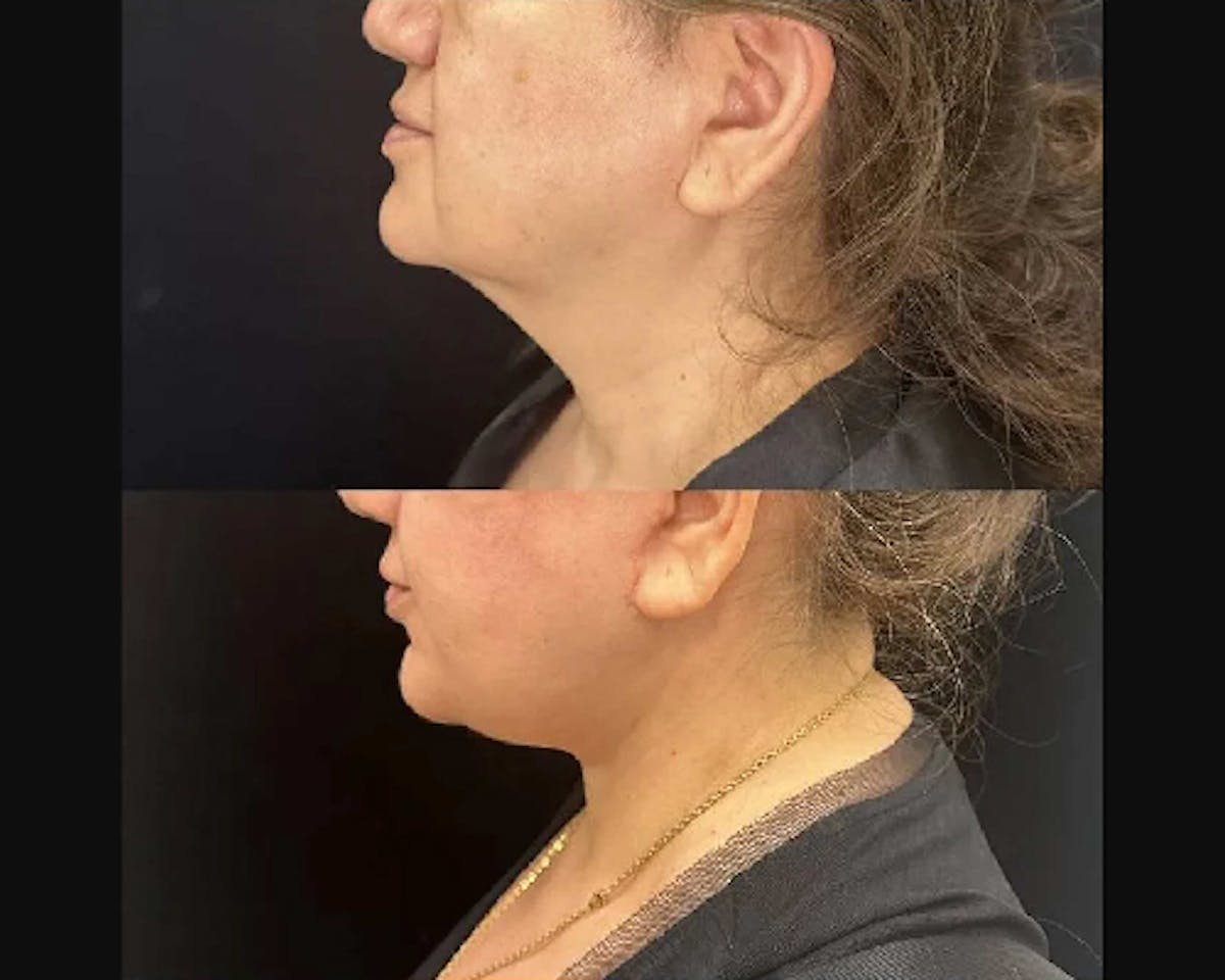 Deep Plane Facelift Before & After Gallery - Patient 260247 - Image 4