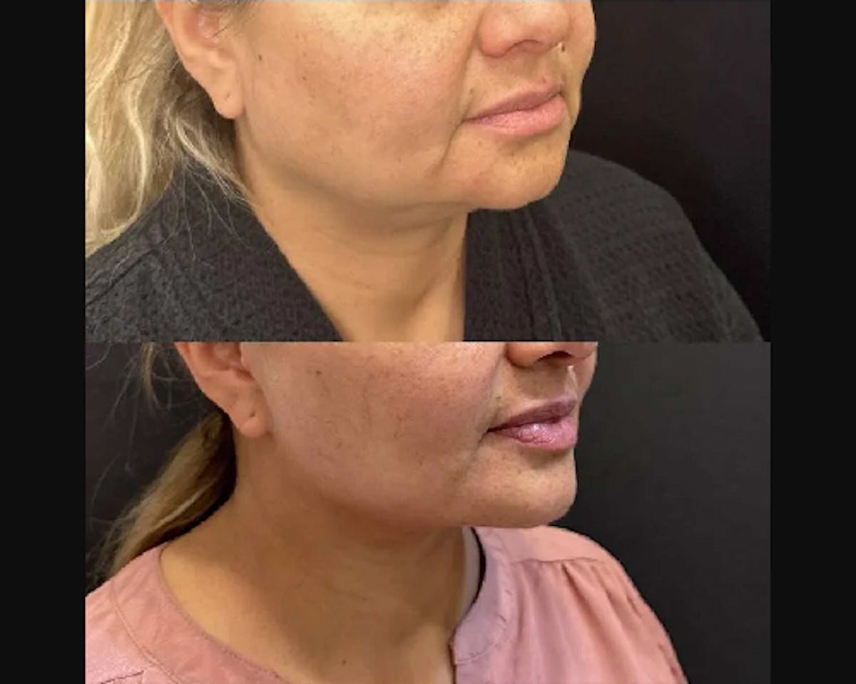 Deep Plane Facelift Before & After Gallery - Patient 174007 - Image 1