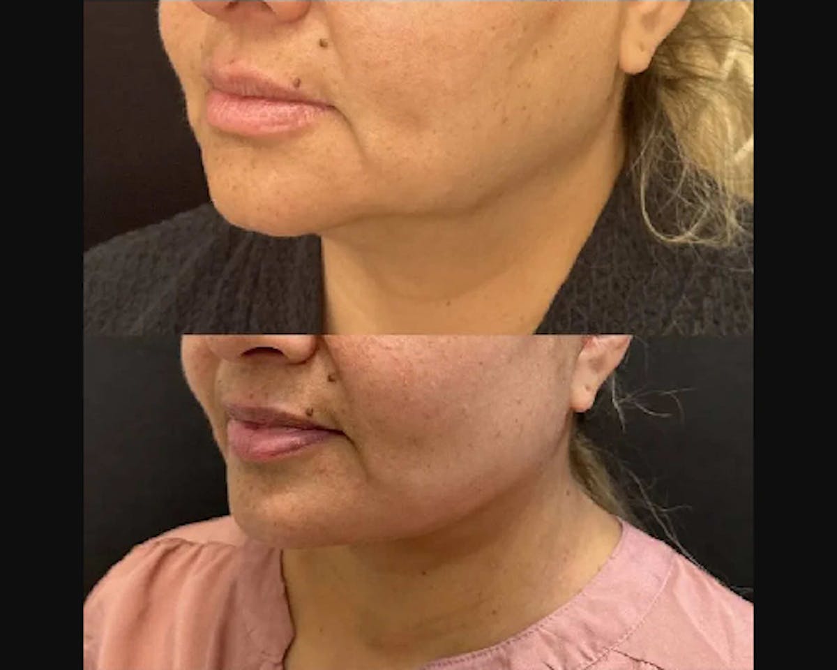 Deep Plane Facelift Before & After Gallery - Patient 174007 - Image 2