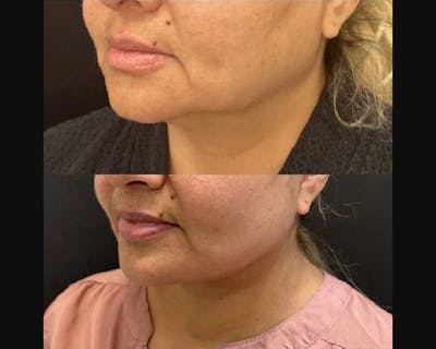 Deep Plane Facelift Before & After Gallery - Patient 174007 - Image 2