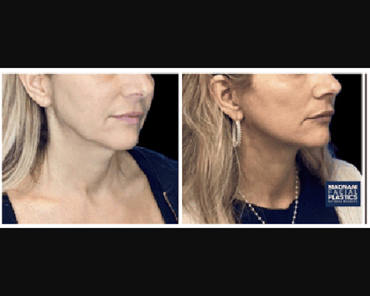 Deep Plane Facelift Before & After Gallery - Patient 427571 - Image 1