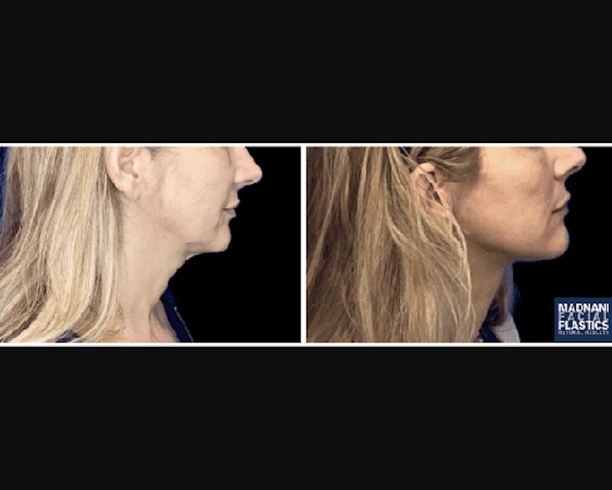 Deep Plane Facelift Before & After Gallery - Patient 427571 - Image 2