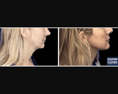 Deep Plane Facelift Before & After Gallery - Patient 427571 - Image 2