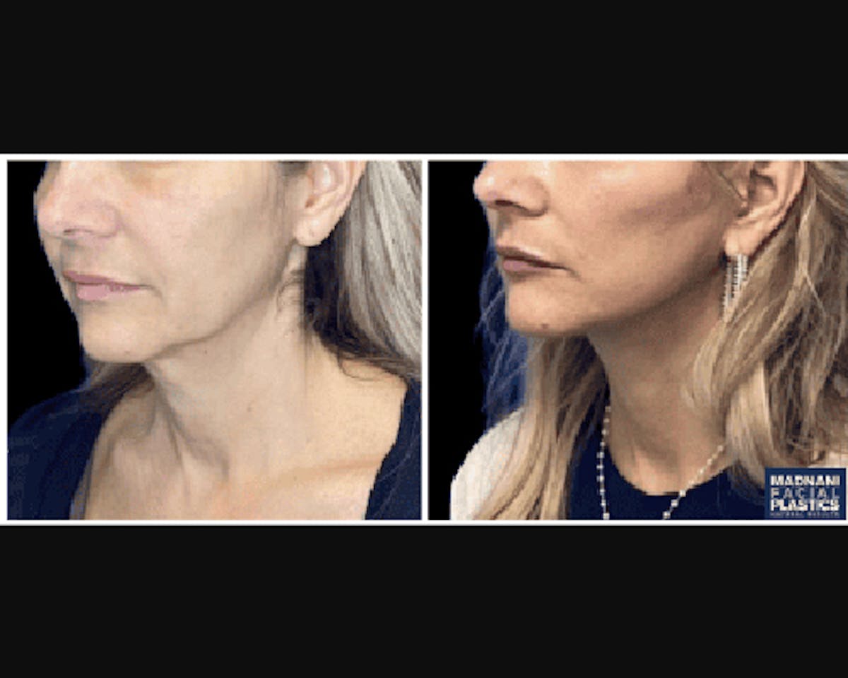 Deep Plane Facelift Before & After Gallery - Patient 427571 - Image 3