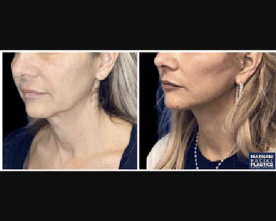 Deep Plane Facelift Before & After Gallery - Patient 427571 - Image 3