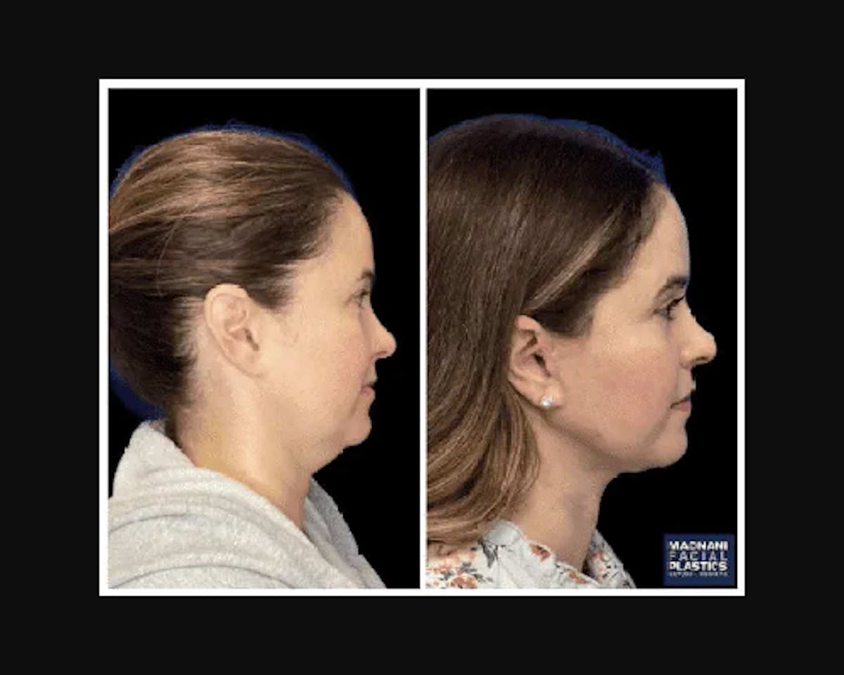 Deep Plane Facelift Before & After Gallery - Patient 115419 - Image 4
