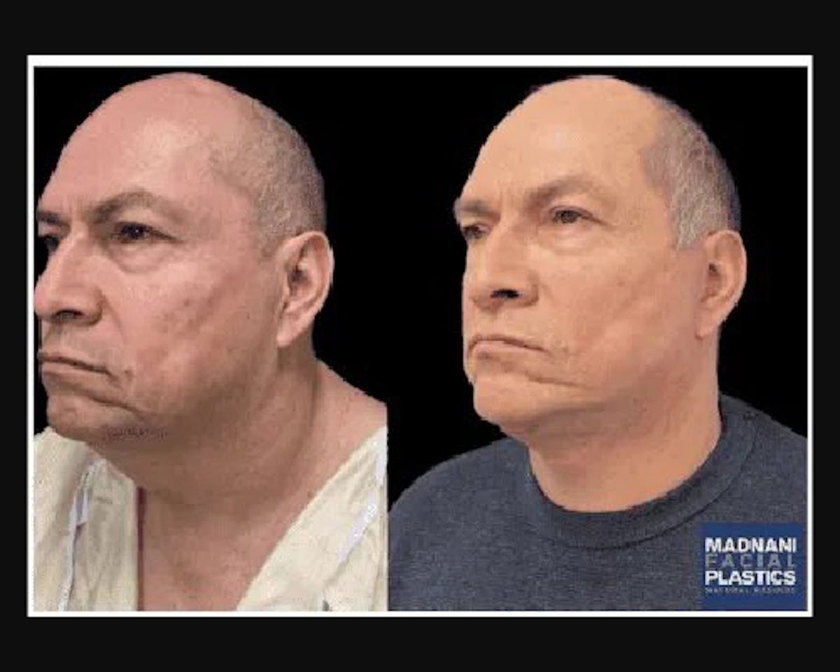 Male Facelift Before & After Gallery - Patient 197351 - Image 1