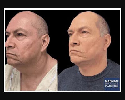 Male Facelift Before & After Gallery - Patient 197351 - Image 1