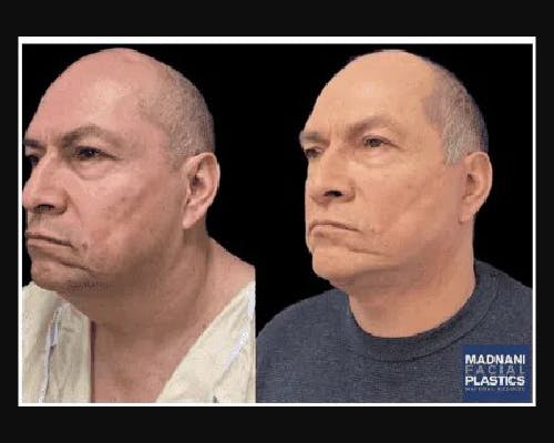 Deep Plane Facelift Before & After Gallery - Patient 307347 - Image 1
