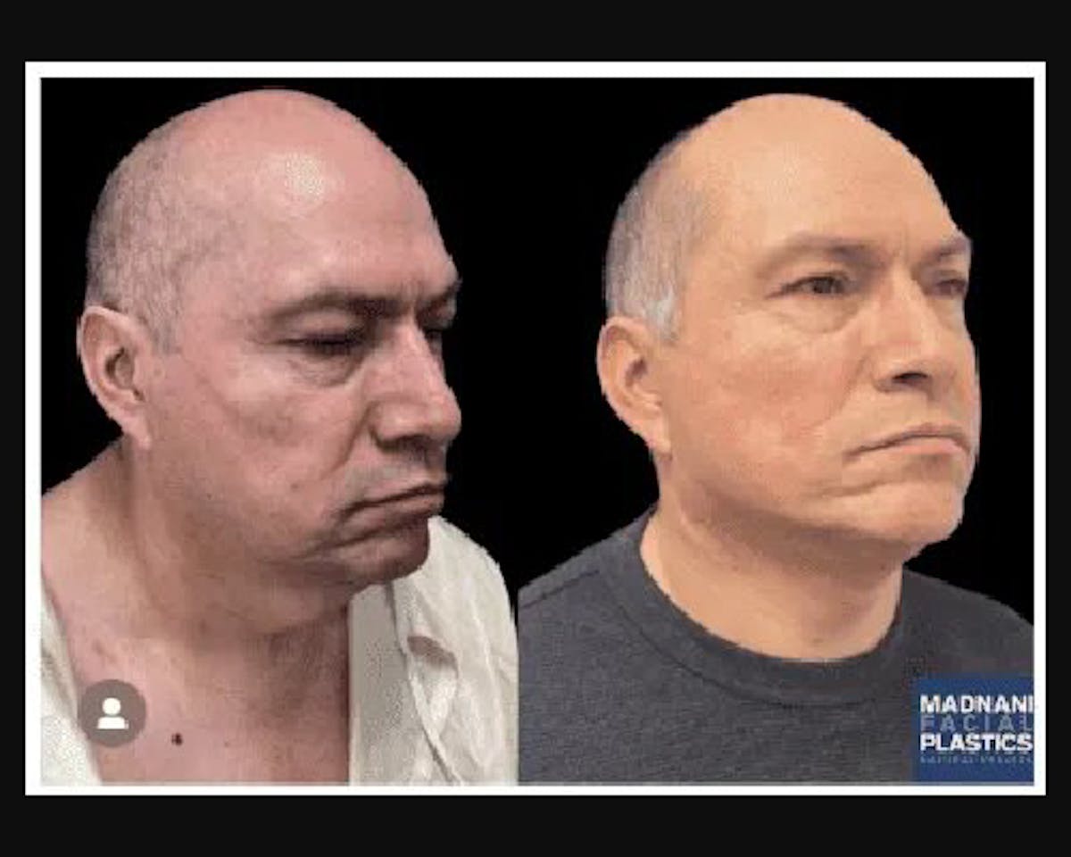 Male Facelift Before & After Gallery - Patient 197351 - Image 2