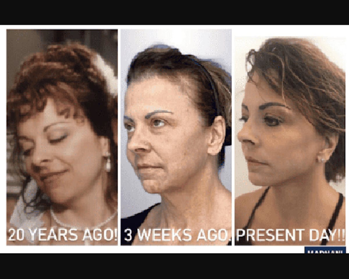 Deep Plane Facelift Before & After Gallery - Patient 874137 - Image 1