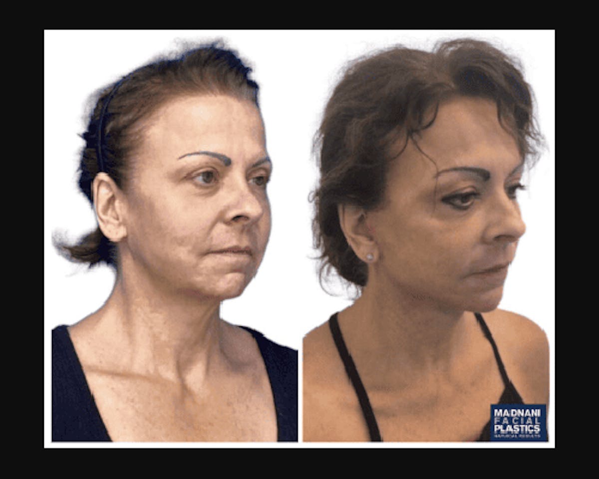 Deep Plane Facelift Before & After Gallery - Patient 874137 - Image 5