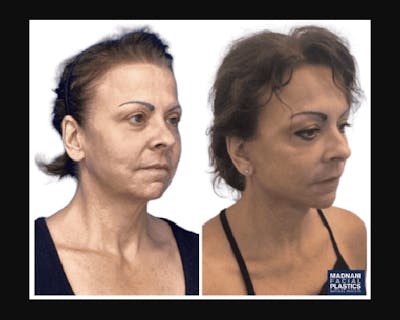 Deep Plane Facelift Before & After Gallery - Patient 874137 - Image 5