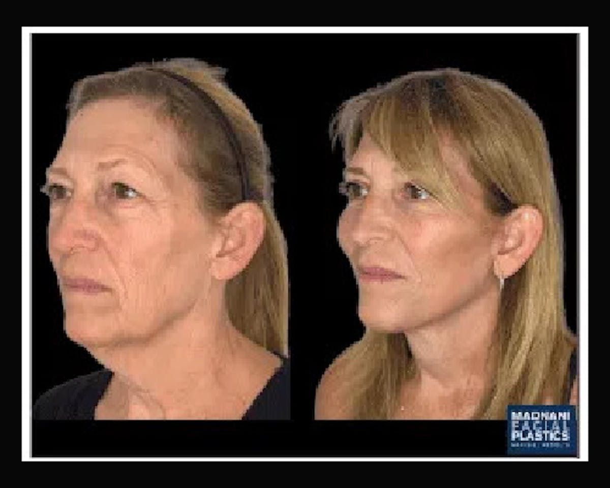 Deep Plane Facelift Before & After Gallery - Patient 138212 - Image 2