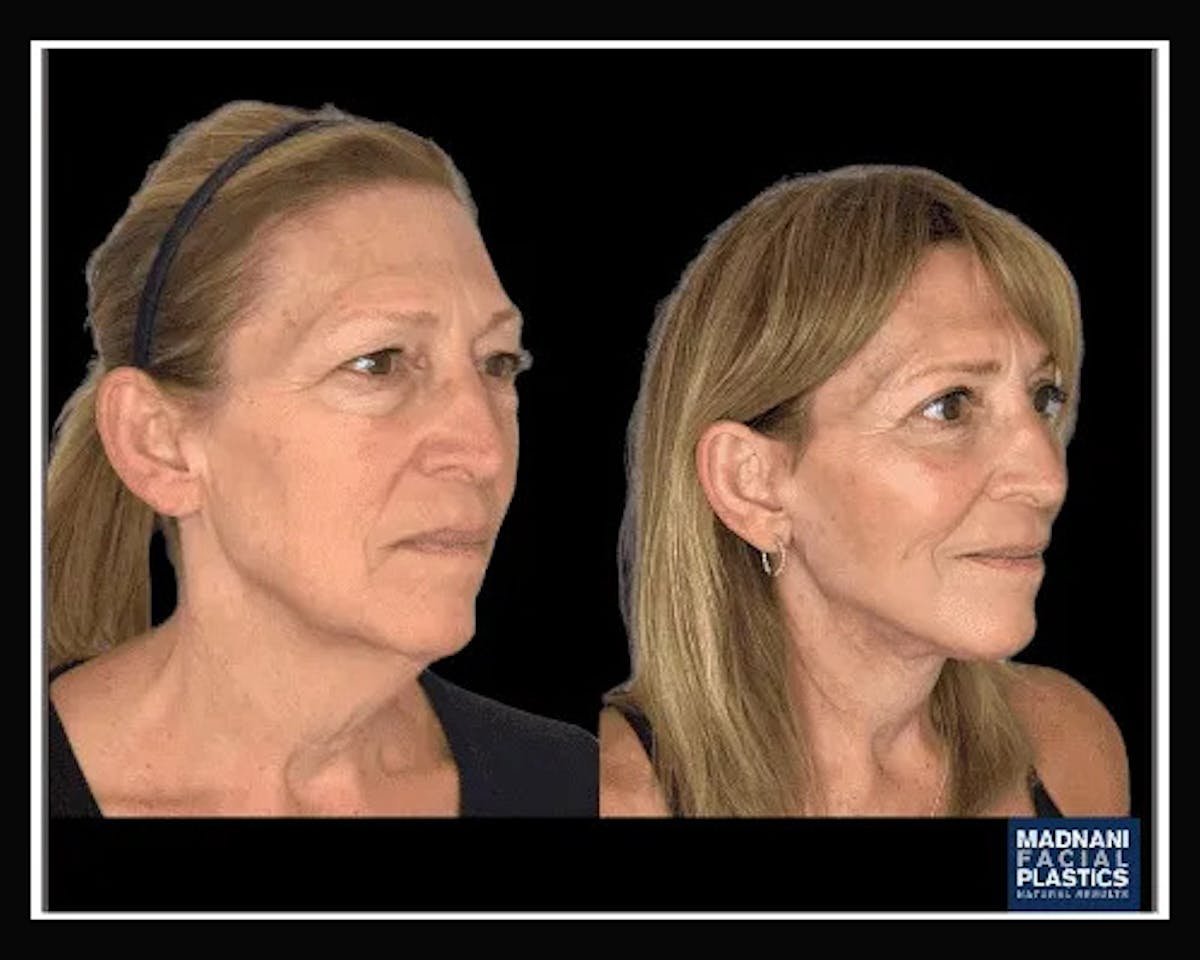 Deep Plane Facelift Before & After Gallery - Patient 138212 - Image 3