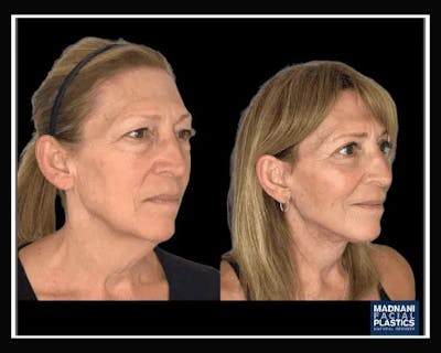 Deep Plane Facelift Before & After Gallery - Patient 138212 - Image 3